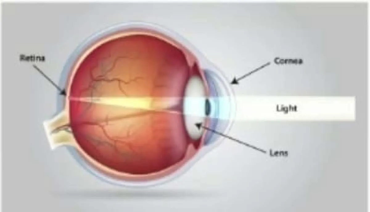 KMN EyeCare Perkenalkan SiLK, Teknologi Non-Flap untuk Efisiensi Prosedur Refraktif