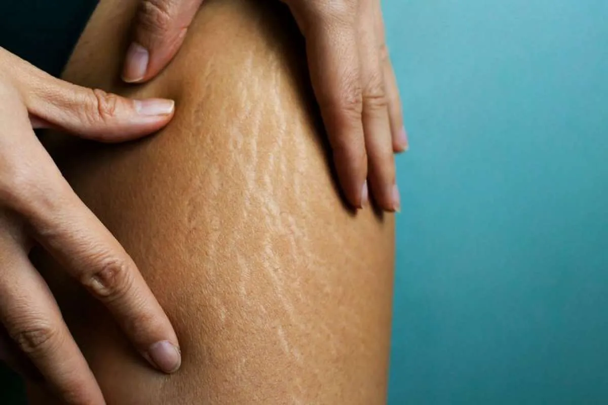 Stretchmark Menggangu? Ini 5 Cara Ampuh untuk Menghilangkannya Moms