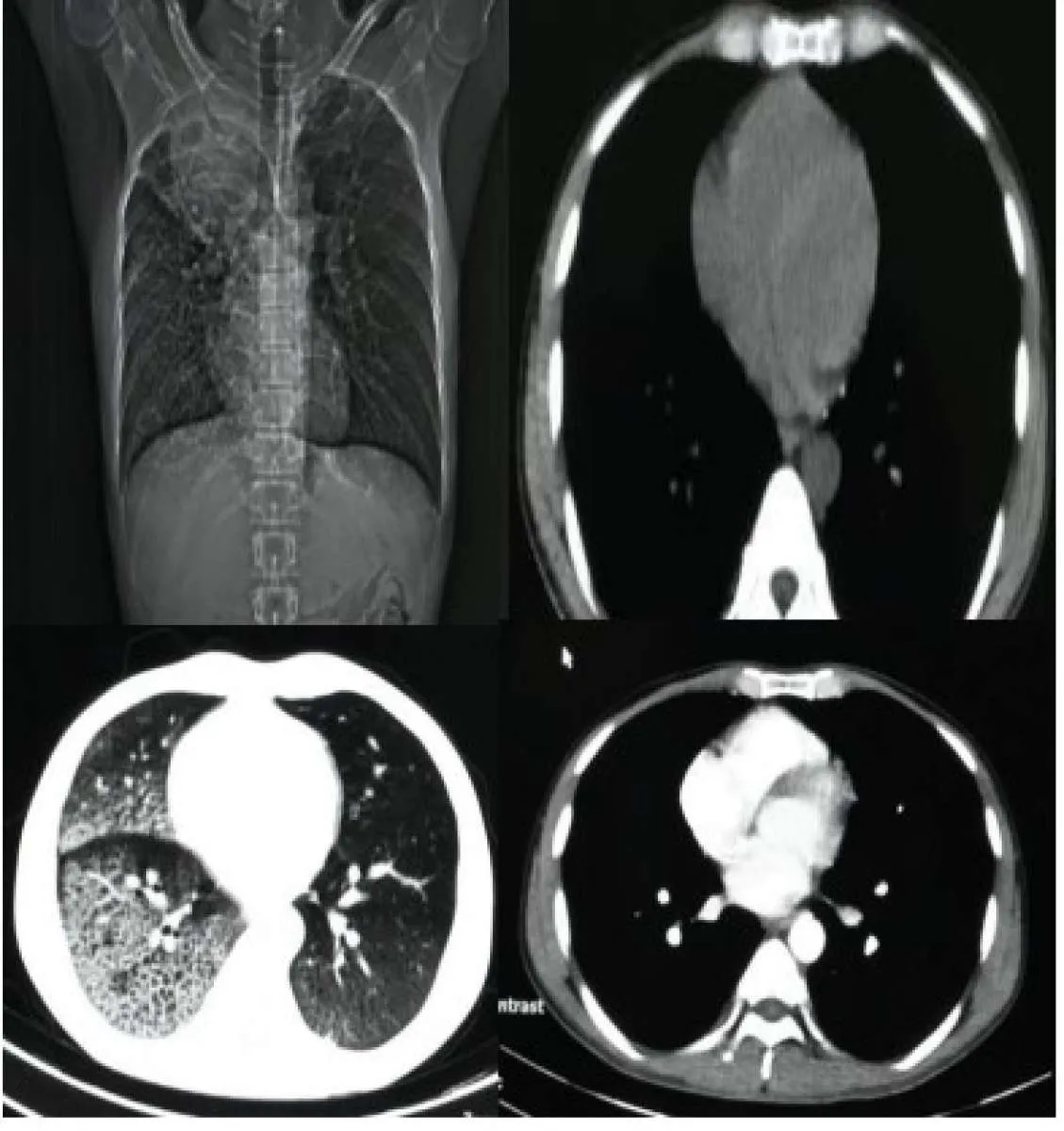 One Stop Service, Deteksi Dini Kanker Paru di RSUP Persahabatan