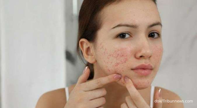 Wajib Dicoba! Ini 5 Rekomendasi Skincare Skintific untuk Hilangkan Jerawat Membandel