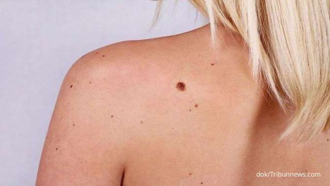 Melanoma (Kanker Kulit): Penyebab dan Gejalanya 