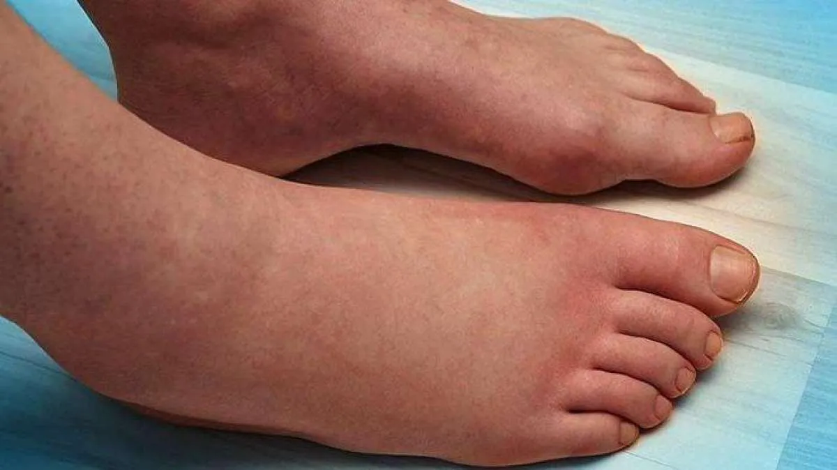 Bisa Dilakukan Sendiri di Rumah! Ini Cara Mengobati Kaki Bengkak Secara Alami 