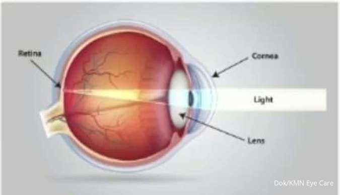 KMN EyeCare Perkenalkan SiLK, Teknologi Non-Flap untuk Efisiensi Prosedur Refraktif