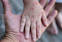 Usia Harapan Hidup Masyarakat Indonesia Meningkat, Kesehatan Semakin Jadi Perhatian