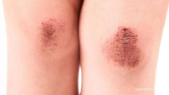 Bisa Dicoba! Inilah Cara Menghilangkan Koreng pada Kaki Secara Alami