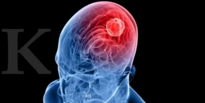 Kenali 10 Gejala Utama Penyakit Kanker Otak Sejak Dini