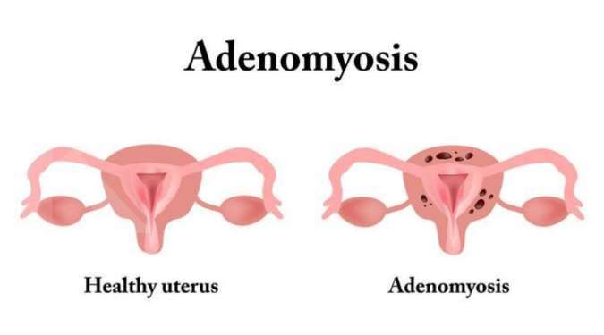 Kenali Gejala Adenomiosis Agar Bisa Memberikan Penanganan yang Tepat