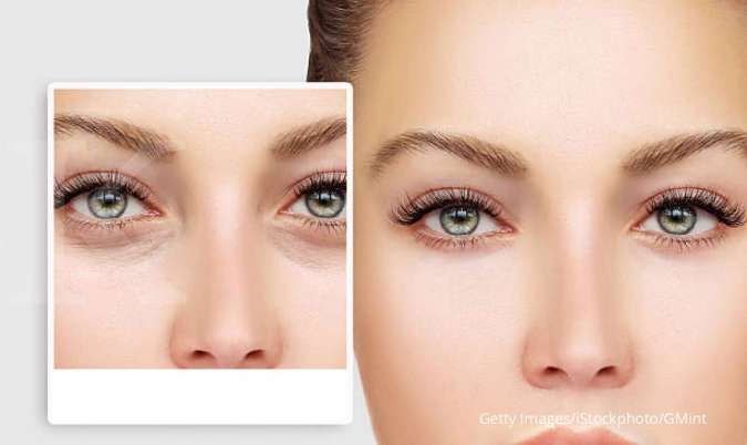 Kulit di Bawah Mata Kendur? Ini 5 Perawatan di Klinik Kecantikan yang Bisa Anda Coba