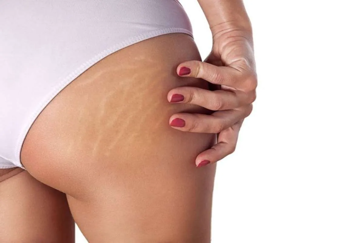 5 Cara Manjur Hilangkan Stretch Mark, Catat Ya!
