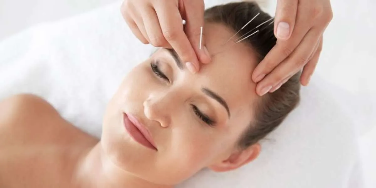 5 Manfaat Akupuntur Wajah, Ampuh Atasi Jerawat dan Kulit Kusam