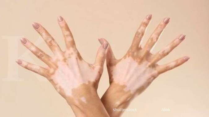 Apa Itu Vitiligo? Bahaya Enggak Sih? Cari Tahu Penyebab dan Cirinya di Sini