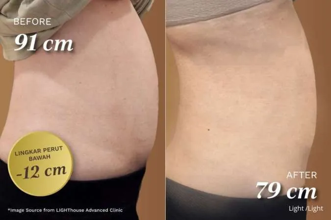 Tips Mengecilkan Lingkar Perut Aman dengan Bantuan Teknologi Ultrasound