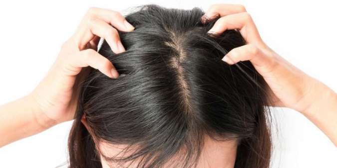 5 Cara Ampuh Menghilangkan Kutu Rambut Menggunakan Bahan Alami