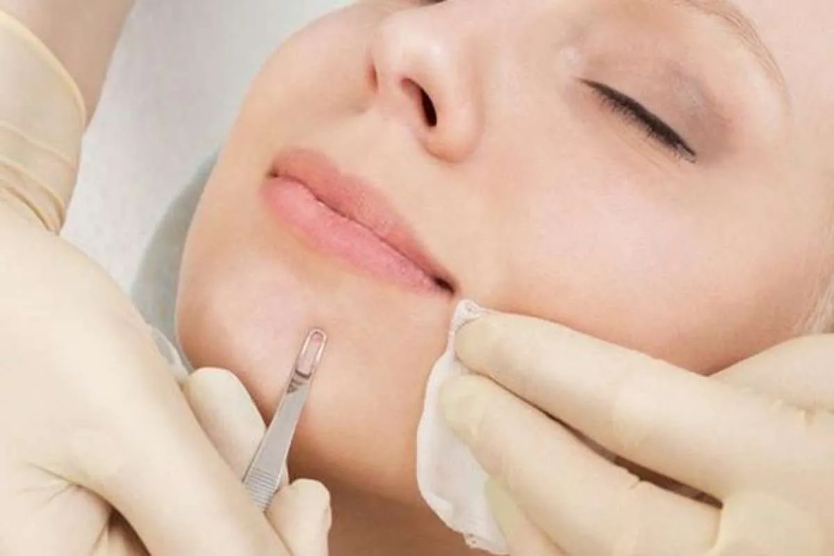 Cara Membersihkan Komedo, Coba 5 Bahan Alami Ini 