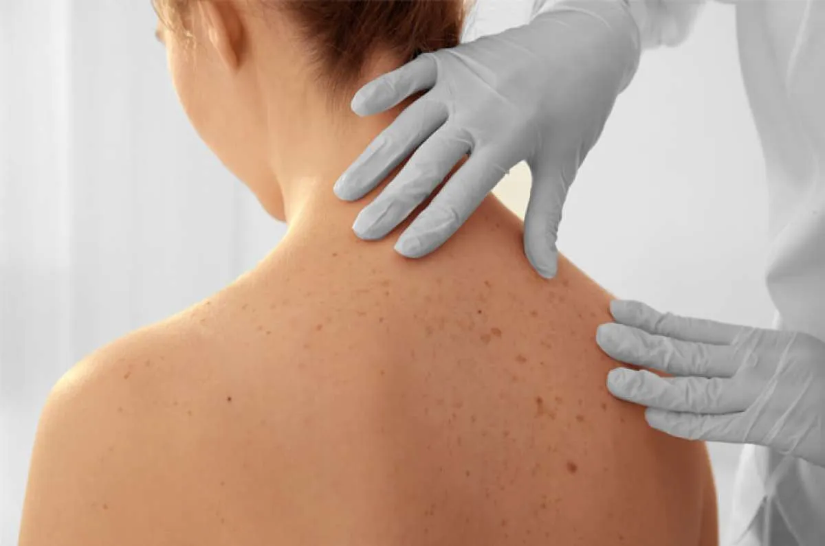 Punya Keratosis Pilaris? 4 Produk Ini Bisa Anda Coba