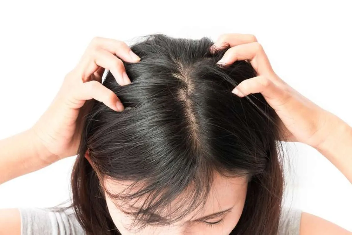 Jerawat di Kepala Bikin Enggak Nyaman? Ini Cara Ampuh Mengatasi Folikulitis