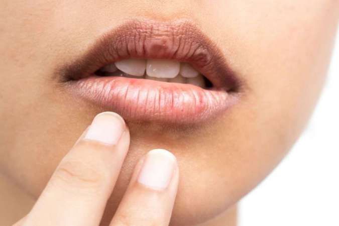 Simak 4 Penyebab Bibir Hitam Pada Wanita, Apa Saja?