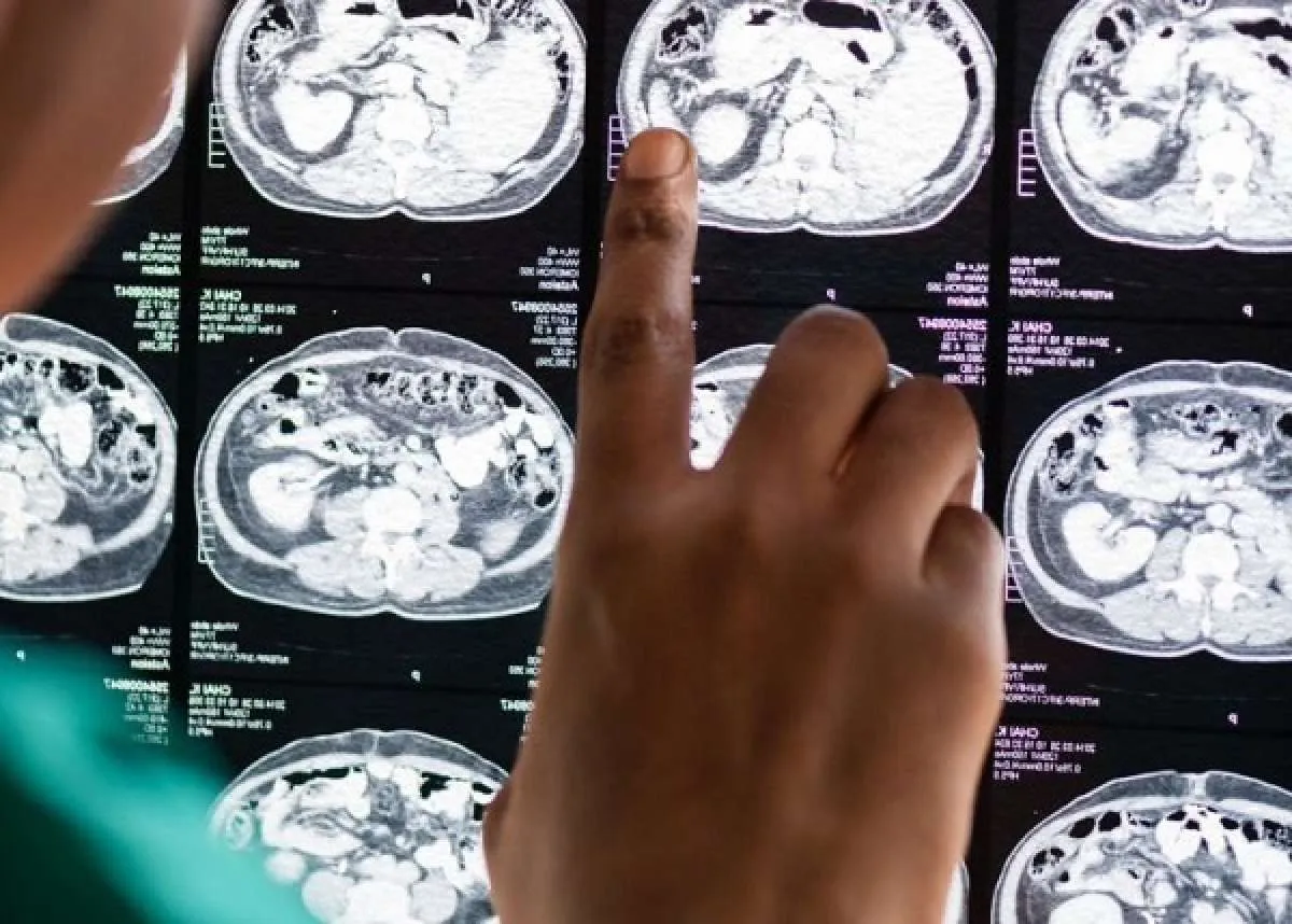 Deteksi Dini Stroke, RS PON Hadirkan Layanan Unggulan Brain Check Up