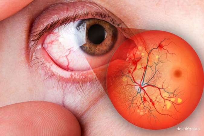 8 Tips Mencegah Retinopati Diabetik pada Penderita Diabetes
