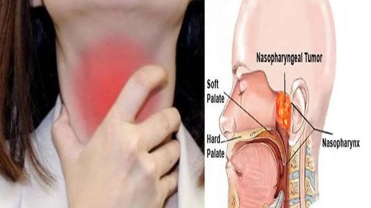 Kanker Nasofaring: Penyebab dan Gejalanya 
