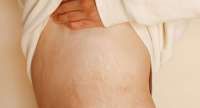 Coba Lakukan 4 Cara Ini Untuk Hilangkan Stretch Mark Pada Tubuh