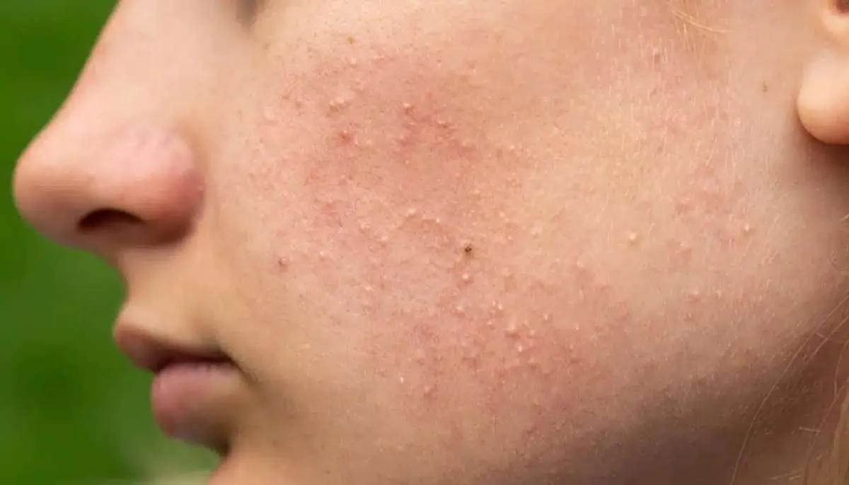 Sekilas Mirip, Ini 5 Perbedaan Fungal Acne dan Beruntusan