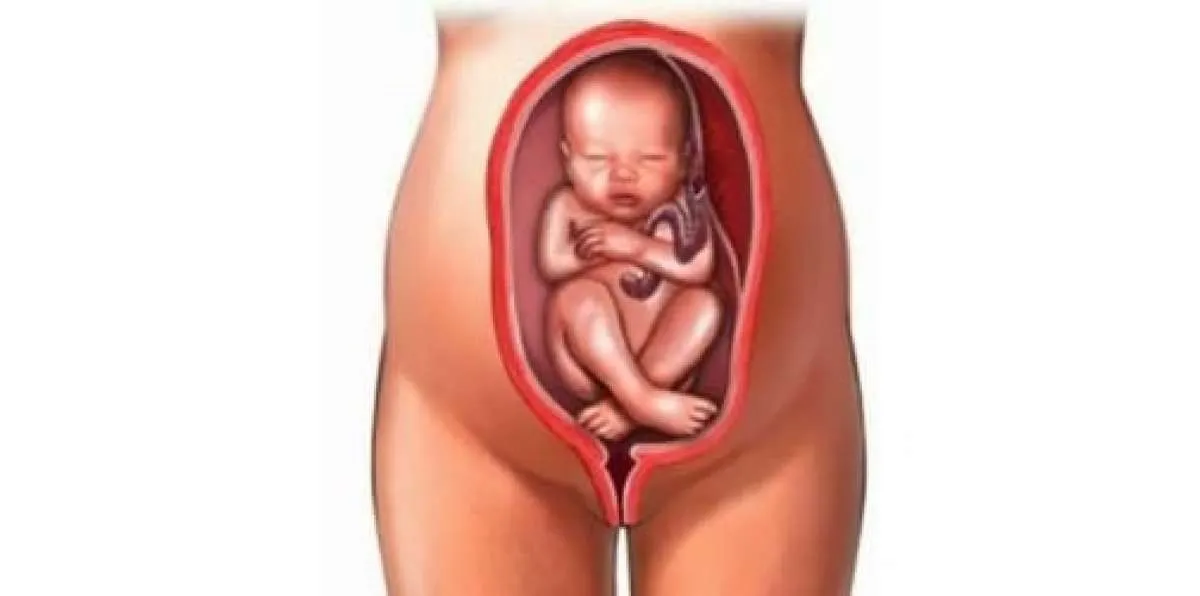 Ibu Hamil Wajib Tahu, 5 Faktor Penyebab Bayi Sungsang Ini Harus Diwaspadai