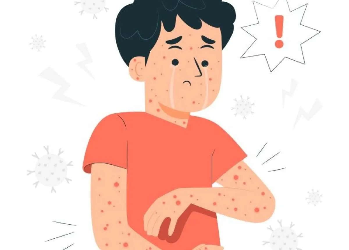 Indonesia Percepat Eliminasi Kusta dan Filariasis, Target Bebas NTDs pada 2030