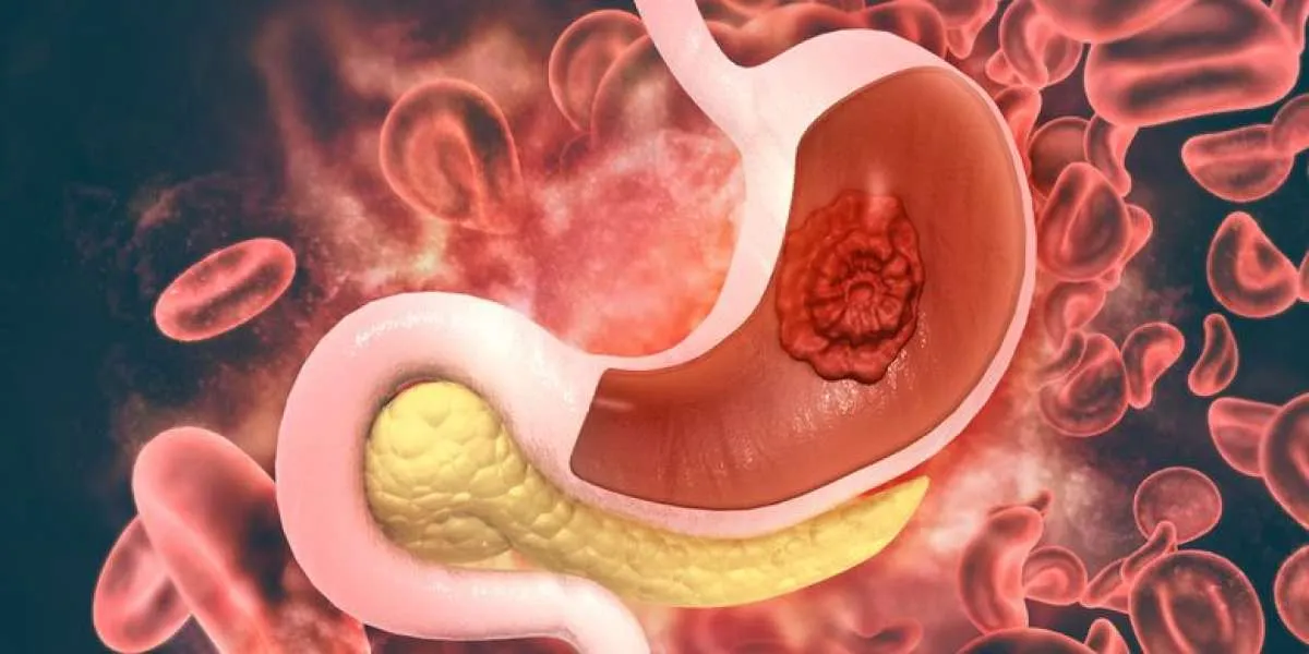 3 Penyebab Gerd Kumat Saat Puasa 