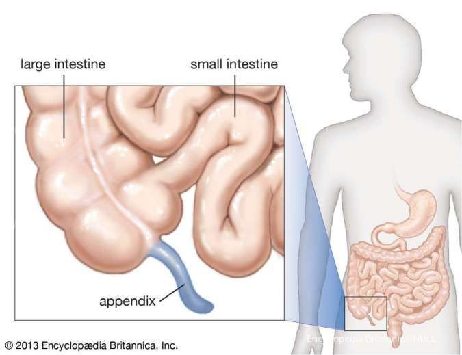 Salah satu penyebab usus buntu adalah pembengkakan jaringan limfa.