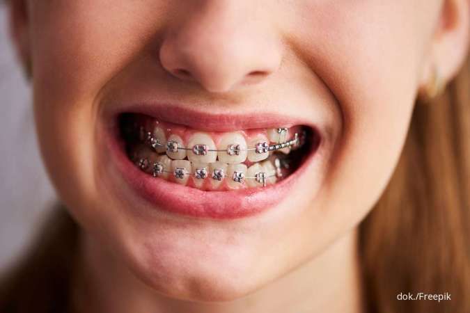 Penting! 3 Tips Merawat Gigi yang Dipasang Behel