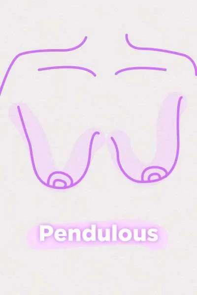 Payudara pendulous