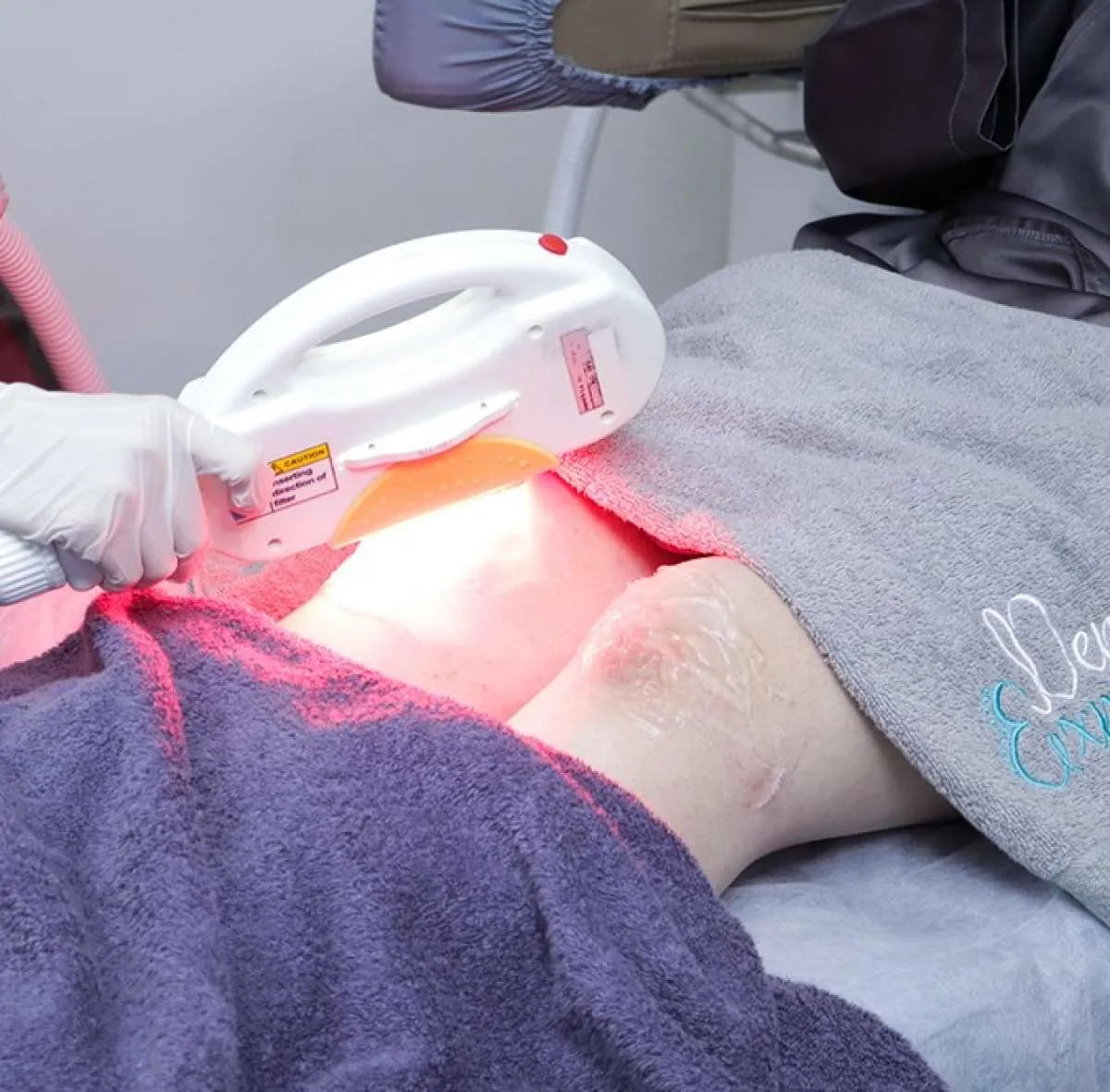 5 Cara Menghilangkan Bekas Luka Membandel 