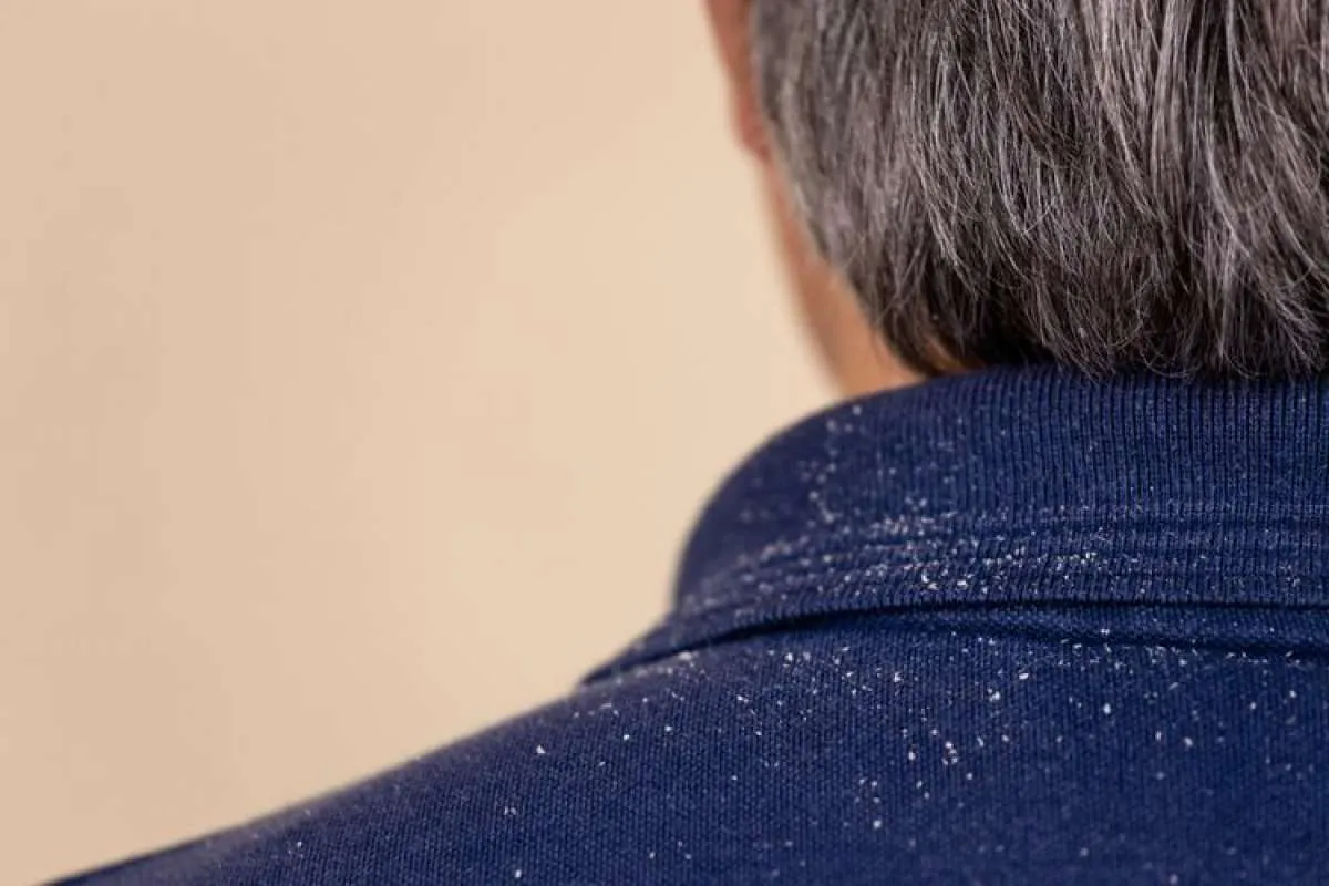 Kotembe membandel? Segera hilangkan dengan obat herbal ini