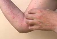 Sepanjang Tahun Ini, Hampir 30.000 Kasus Mpox Terdeteksi di Afrika 