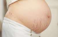 5 Cara Mencegah Stretch Mark Muncul di Masa Kehamilan, Kontrol Berat Badan Moms