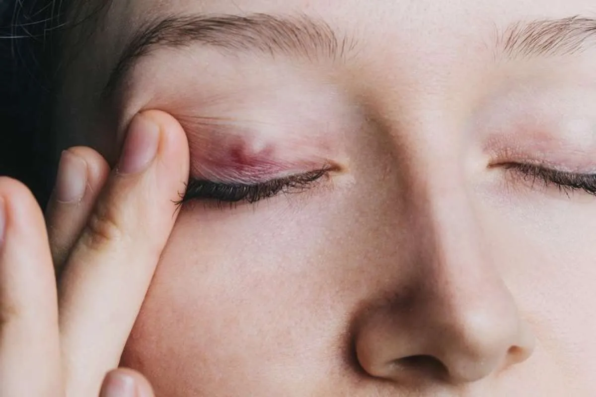  Jangan Sepelekan Benjolan di Kelopak Mata, Kenali Penyebab dan Cara Penyembuhannya