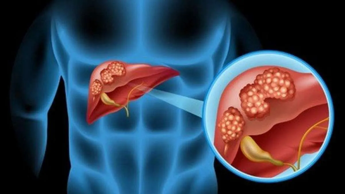 11 Tanda Liver Anda Bermasalah yang Tidak Boleh Diacuhkan, Coba Cek Sekarang!