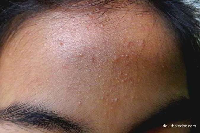 Pahami 5 Cara Mengatasi Bruntusan di Wajah dengan Produk Skincare