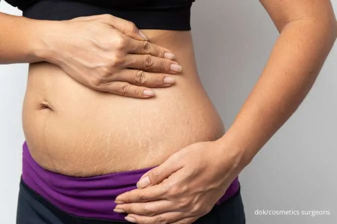 Ibu Hamil Wajib Tahu Cara Cegah Stretch Marks dengan 5 Rahasia Ini