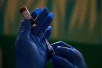 Dokter Muda Di RSUD Cianjur Meninggal Karena Campak, Kenali Ciri-Ciri Tertular Campak