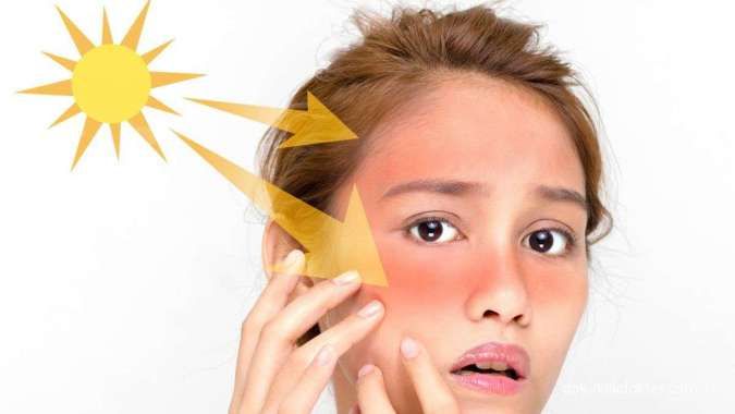 Pahami 5 Cara Mengatasi Kulit Wajah Terbakar Akibat Sinar Matahari