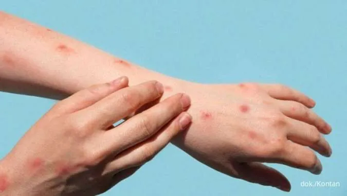 Apa Saja Gejala Mpox atau Cacar Monyet? Intip Selengkapnya di Sini