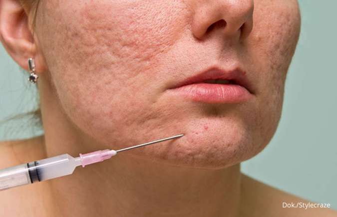 5 Cara Menghilangkan Bopeng Bekas Jerawat Paling Ampuh, Bikin Wajah Mulus Lagi