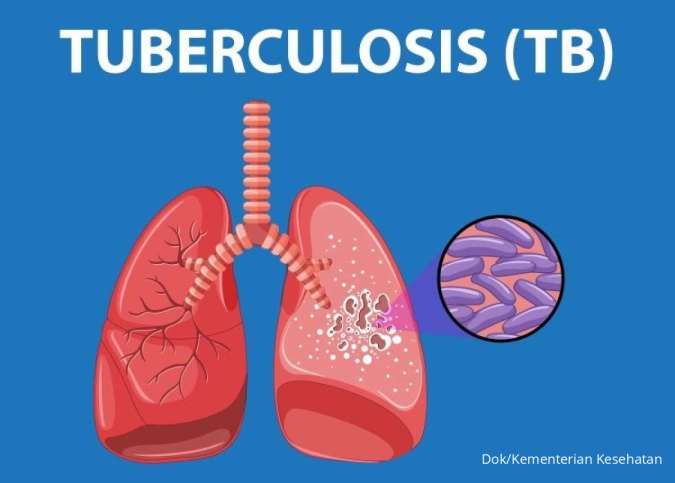 Sejarah Hari TBC Sedunia 24 Maret: Nama Penemu Penyakit TBC dan Vaksin BCG