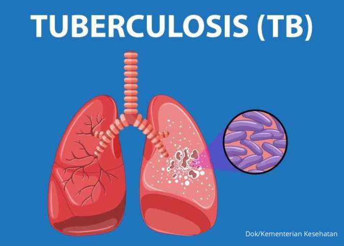 Mengenal Penyakit TBC, Penyebab, Gejala, dan Langkah Pencegahan TBC