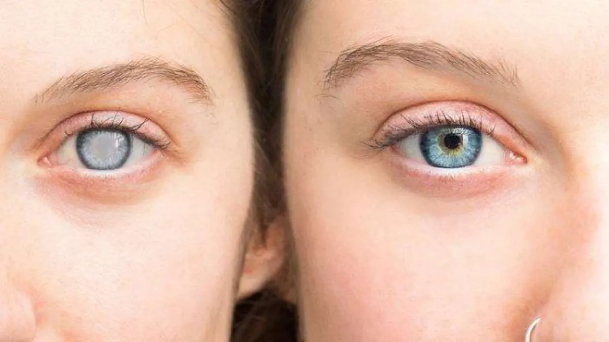 6 Gejala Katarak yang Tidak Boleh Dianggap Sepele oleh Penderita Diabetes