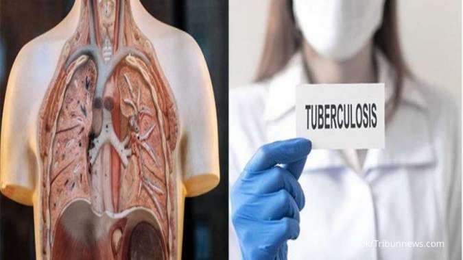 Penyakit TBC: Penyebab, Gejala, dan Cirinya saat Sudah Parah