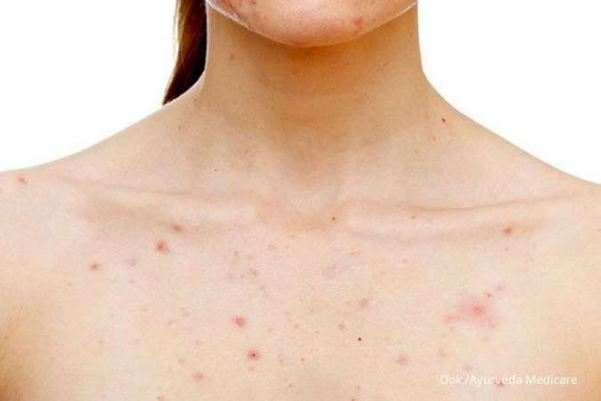Singkirkan Fungal Acne yang Mengganggu dengan 5 Perawatan Sederhana Ini