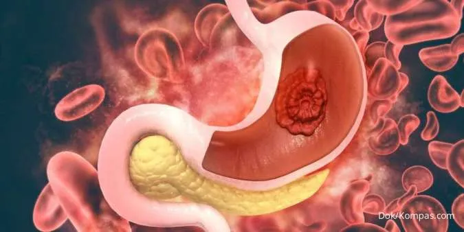 Bayi Sering Gumoh, Dokter Jelaskan Bedanya Regurgitasi dan GERD